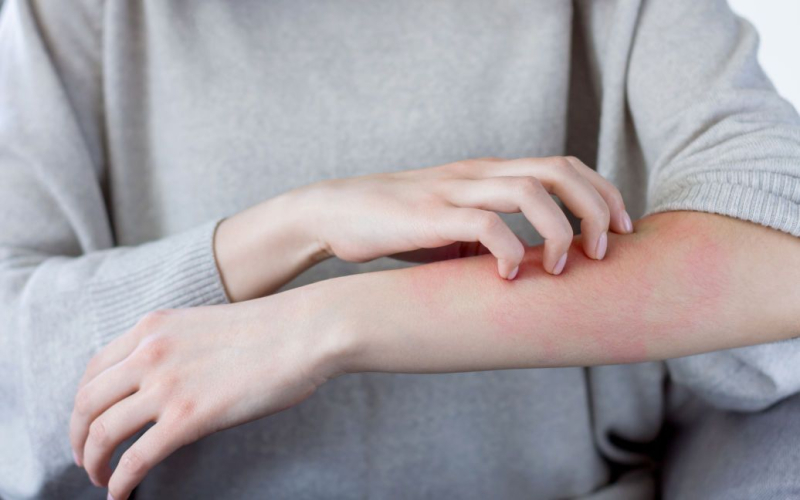 Что такое аллергия на холод: как проявляется и чем лечить